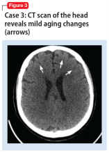 Case 3: CT scan of the head reveals mild aging changes (arrows)