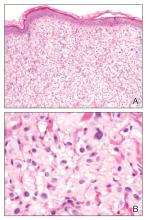 Asymptomatic Nodule on the Back | MDedge