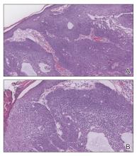 Friable Scalp Nodule | MDedge