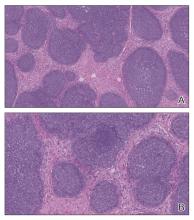 Friable Scalp Nodule | MDedge