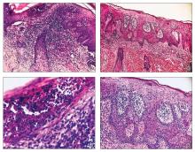 Psoriatic Alopecia in a Patient With Crohn Disease: An Uncommon ...