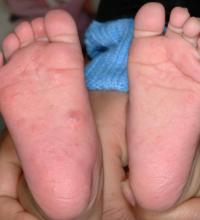 This image shows scabies papules and burrows on the soles.