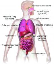 Illustration of some of the major effects of cystic fibrosis on body systems