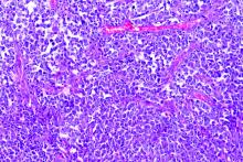 Diffuse large B-cell lymphoma (DLBCL) of the small intestine with mucosal ulceration and invasion of the mesenteric fat tissue. H&amp;E Stain.