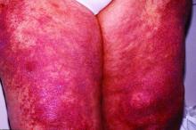 This womean shows dermatomyositis rash on her thighs.