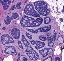 Dome-Shaped Periorbital Papule | MDedge