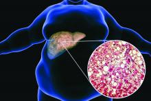 Obese man with fatty liver, 3D illustration and photomicrograph of liver steatosis.