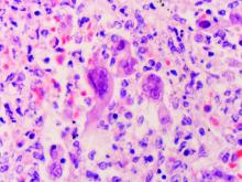 Large, multinucleate virus-infected cells with typical eosinophilic Cowdry Type A inclusions are present.