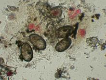 This microscopic image shows scabies eggs and scybala (feces).