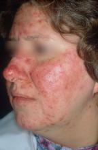 A woman with inflammatory rosacea.