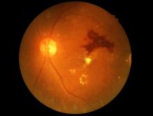Diabetic retinopathy from the eye of a patient is shown.