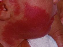 Facial port wine stain in an infant