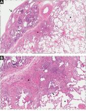 Histopathologic appearance of definite pattern of usual interstitial pneumonia (UIP)