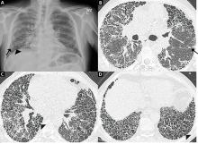 Radiographic patterns of definite usual interstitial pneumonia