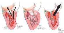 Figure 6. Reorientation surgery reduces mobility of bifid hypermobile papillary muscles, reducing LVOT obstruction.