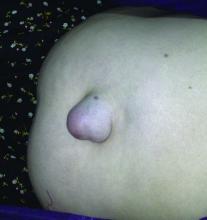 Umbilical hernia