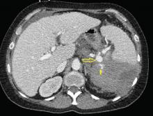 Computed tomography of the abdomen demonstrates splenic aneurysm