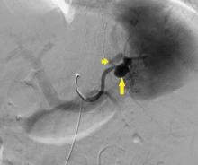 Angiography before treatment demonstrates splenic aneurysm