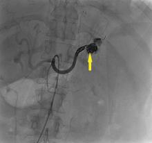 Angiography after embolization demonstrates coils in the embolized aneurysm