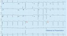 Electrocardiography at presentation showed a corrected QT interval of 360 msec.