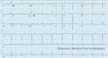 An electrocardiogram 4 months earlier showed no ST-segment elevations or ST-segment depressions.