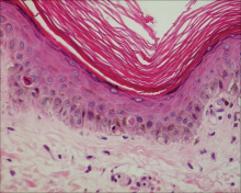 Space Heater–Induced Bullous Erythema Ab Igne | MDedge