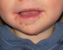 Rash around the mouth of a child