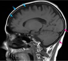 Magnetic resonance imaging (sagittal view) without contrast reveals significant frontotemporal atrophy (blue arrows) and deep sulci within the frontal lobe, features not as prevalent in occipital and cerebellar territories (red arrows).