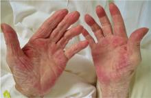 The patient had symmetrical palmar erythema.