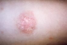 A close-up of an oval &amp;quot;herald patch&amp;quot; on the skin of a patient with pityriasis rosea.