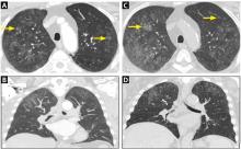 Axial computed tomography of the chest 1 year before this clinic visit .