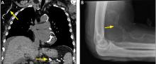 CT with coronal reconstruction showed densely calcified vessels (arrows), as did plain radiography of the elbow.