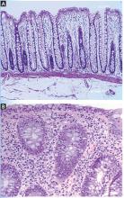 Histologic features of immune checkpoint inhibitor-associated colitis