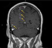 Figure 1. Magnetic resonance imaging identified multiple ring-enhancing lesions (arrows) in the right hemisphere.