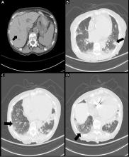 Chest computed tomography axial views