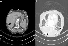 Chest computed tomography 