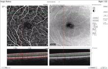 OCT angiographic scan of the retina. The bottom two panels show structural imaging of the retinal layers. Retinal nerve fiber layer is the light-colored top layer. Red in the bottom left image indicates active blood flow over 3 seconds.