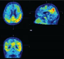 PET imaging with a tau radioligand shows tau accumulation in the temporal lobe (red).