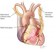 Sites of bilateral mammary grafting and radial artery bypass.