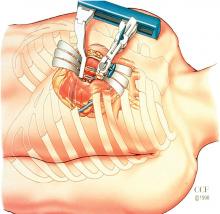 Exposure of the left anterior descending for a minimally invasive direct coronary artery bypass.