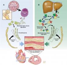 The 2 main types of amyloidosis that affect the heart.