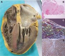  Cardiac amyloidosis pathology.