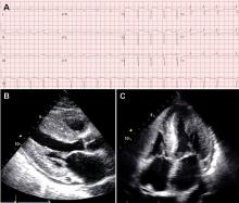 The classic hallmark of cardiac amyloidosis.