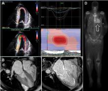 Noninvasive imaging for cardiac amyloidosis.