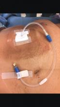 Tips and Tricks: Dealing with a troublesome peritoneal dialysis ...