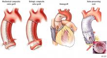 The 4 types of ascending aorta and aortic root replacement surgeries.