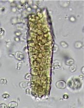 A red blood cell cast in a patient with glomerulonephritis.