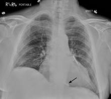 A leadless pacemaker in the right ventricle.