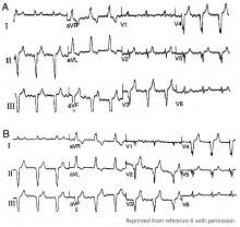 Typical 12-lead electrocardiogram showing right bundle branch block morphology 