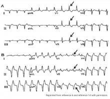 Electrocardiogram from a patient with known left ventricular lead position through a patent foramen ovale